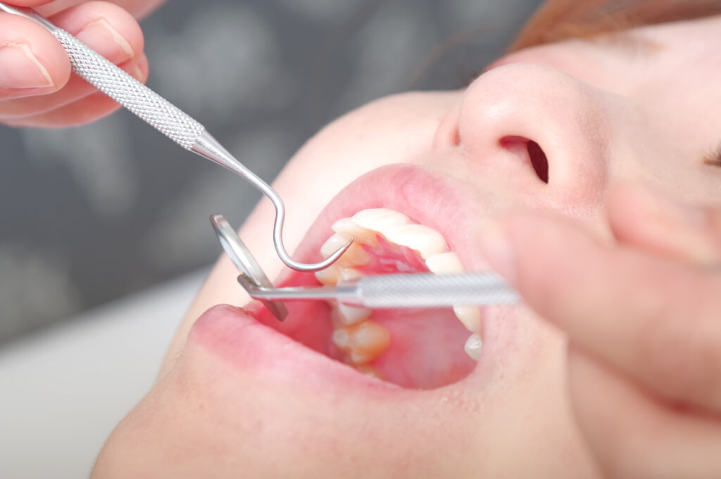 jus de pomme caries