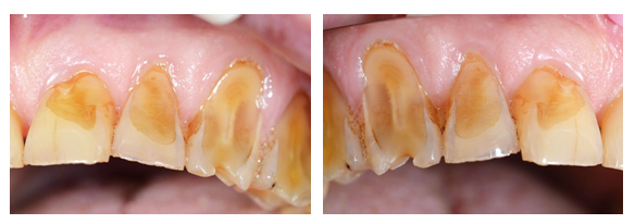 conséquences reflux gastro-oesophagien