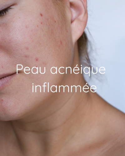 bois ta skincare acnée
